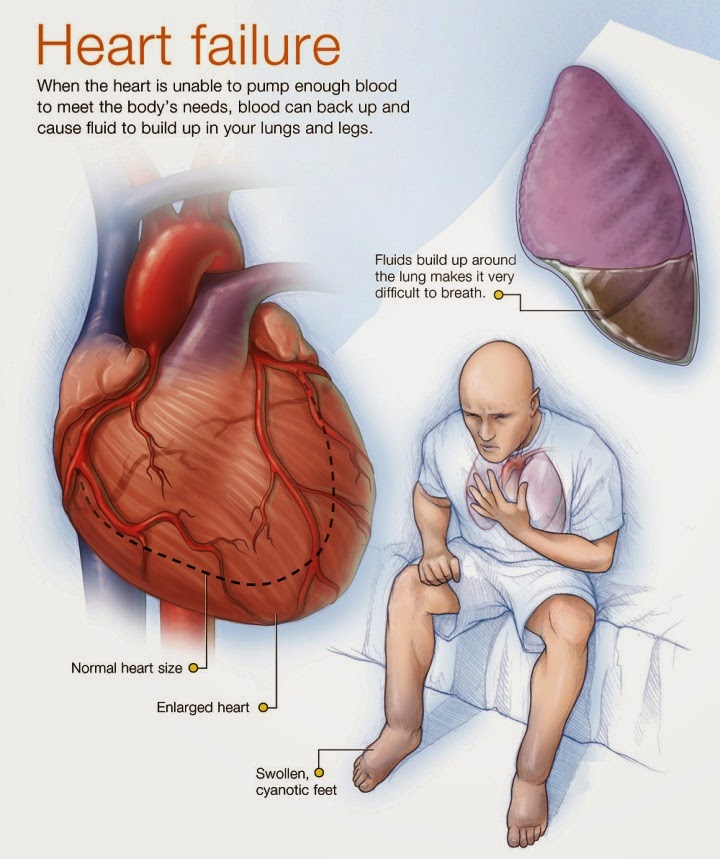 heart-failure-management-dr-rahul-kaiche