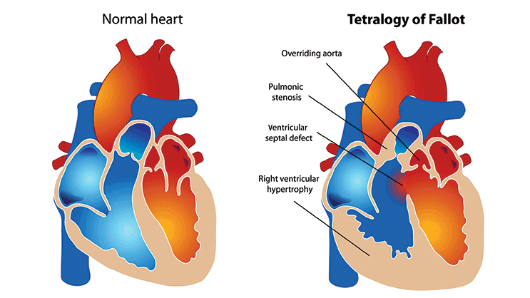 heart surgery in nashik