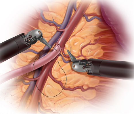mininmally invasive cardiac surgery