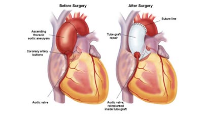 Valve replacement and repair surgery